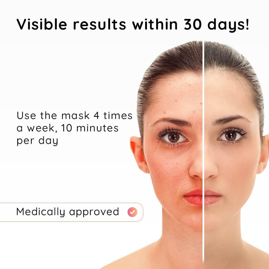 Red Light Therapy Face Mask